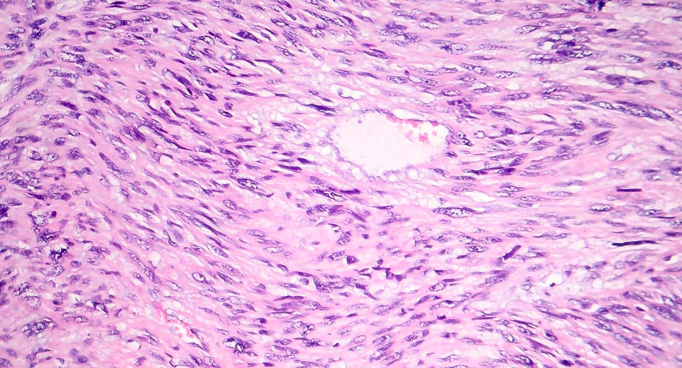 平滑肌肉瘤，一种恶性癌性平滑肌肿瘤，光学显微照片，显微镜下的照片