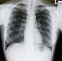 肺射线
