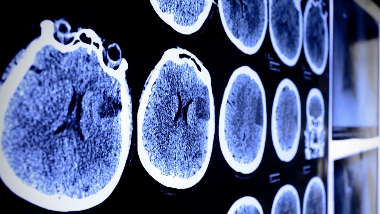 Cancerwise博客文章:关于脑肿瘤，脑肿瘤治疗和脑肿瘤临床试验需要了解什么