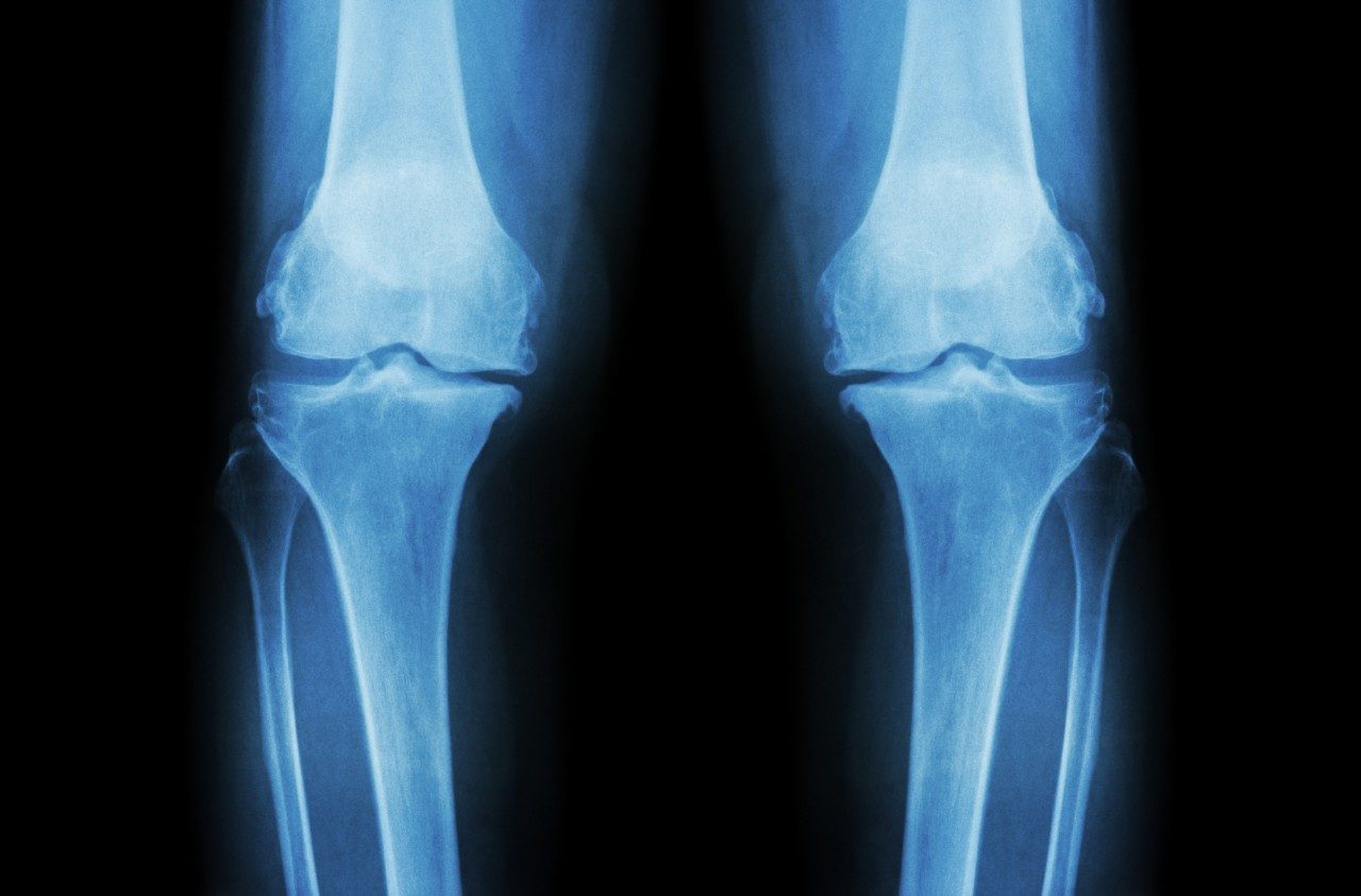 癌症方面的博客:膝盖的x光片，尤文氏肉瘤，骨肉瘤，异体移植，软组织肉瘤