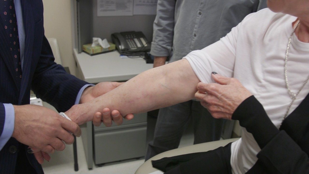 手臂正在检查淋巴水肿，这是一种常见的癌症治疗副作用