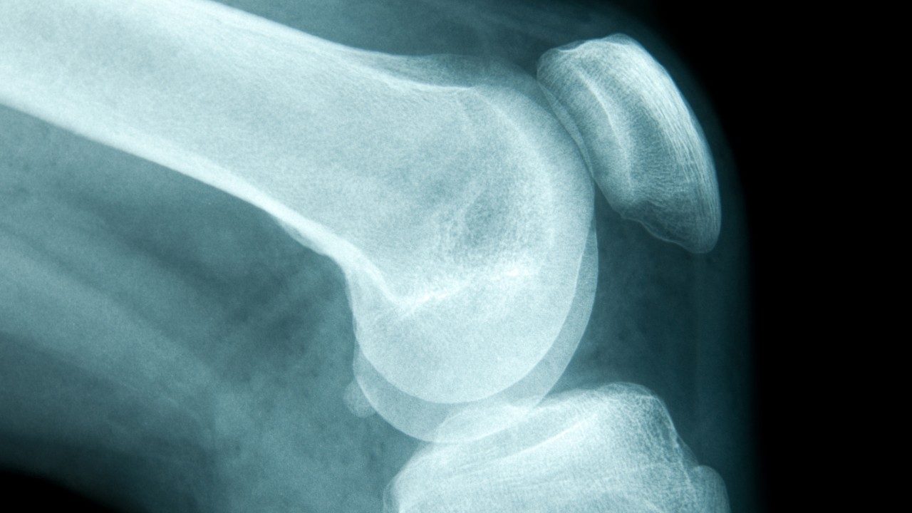 膝盖和腿部骨头的X射线