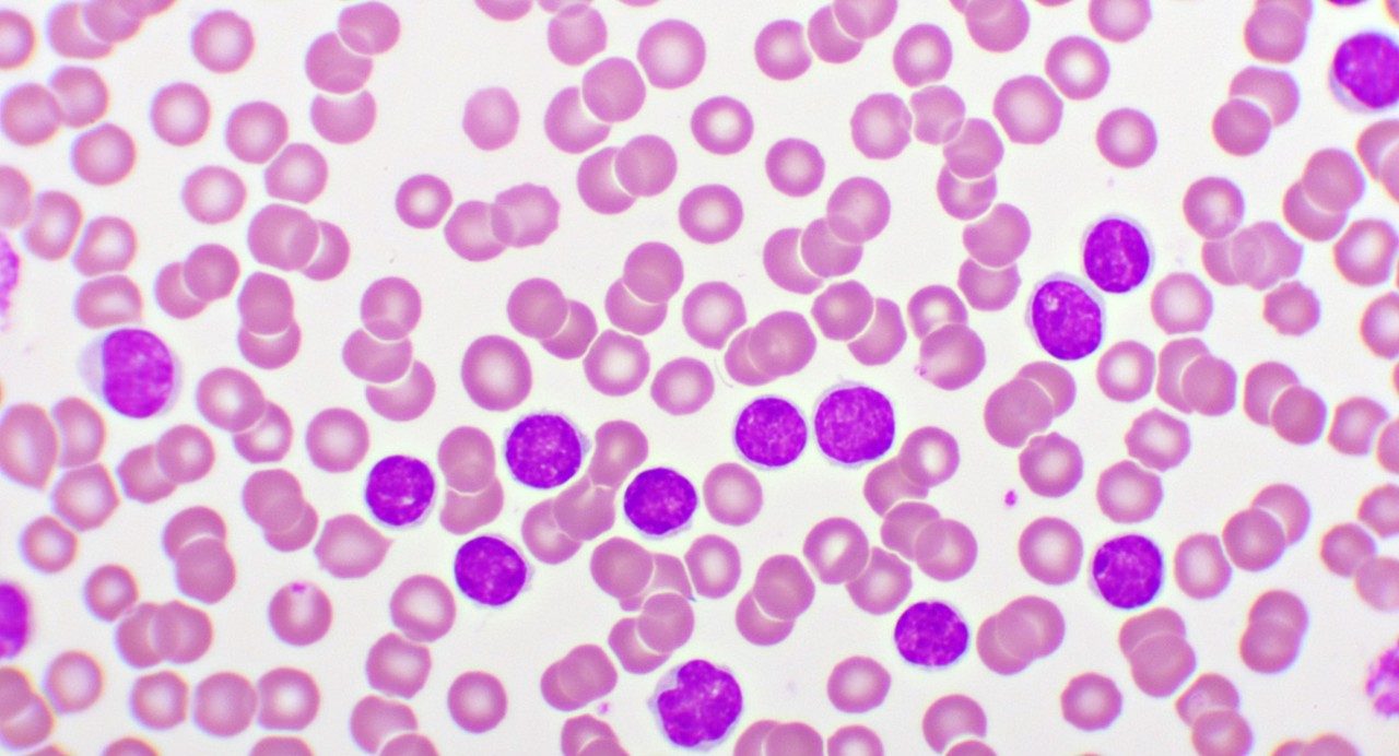 急性骨髓白血病细胞的显微镜图像