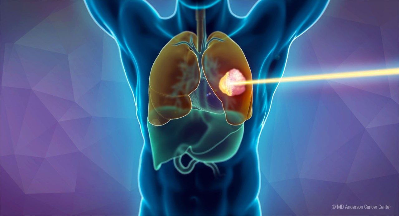质子治疗束靶向肺癌的图解