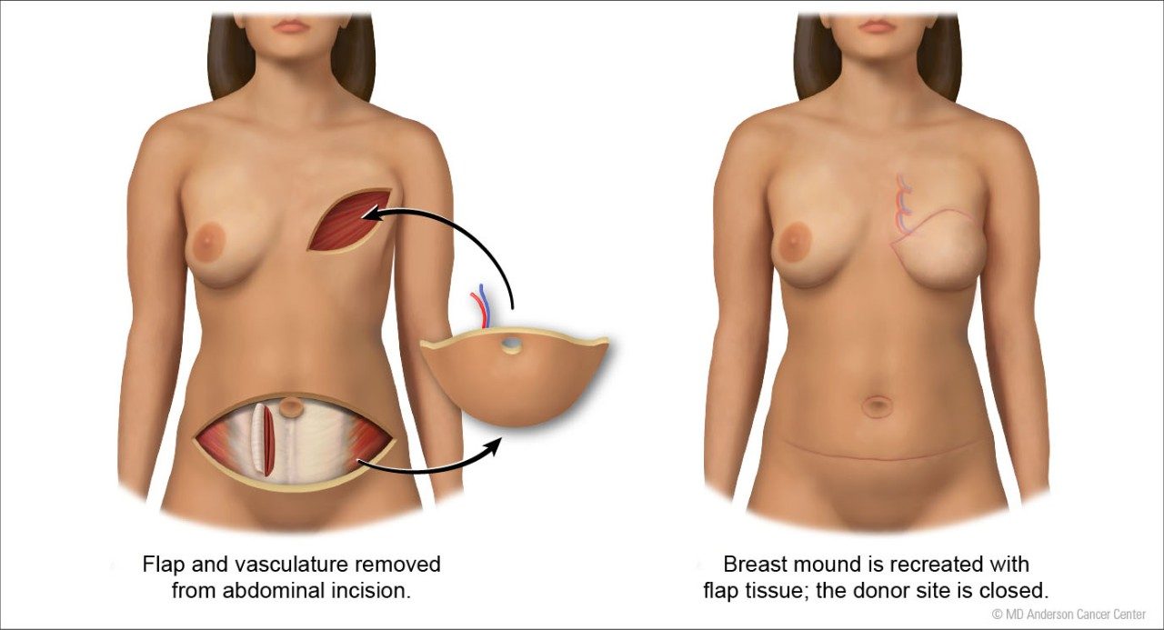 Diep皮瓣程序的例证在乳房重建的由jordan pietz