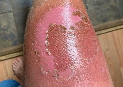 洛根卡弗腿从植物口炎恢复痛水泡持续近2周后受损皮肤开始下降