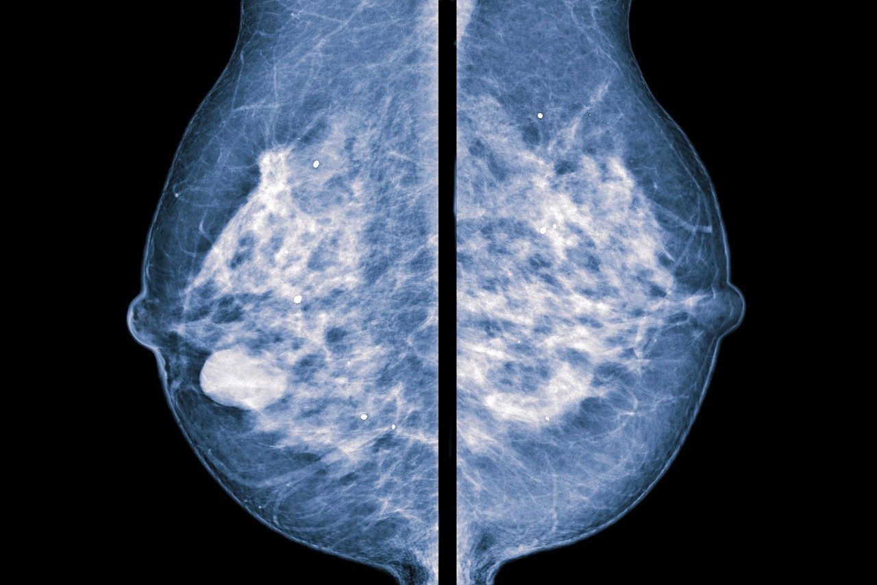 乳房x光图像显示乳房钙化