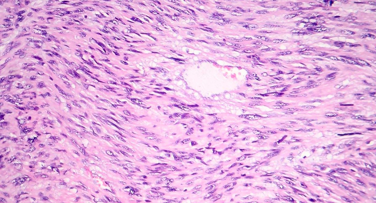 Leiomyosorma,恶性癌症滑动肌肉肿瘤,光线显微图,显微镜下照片