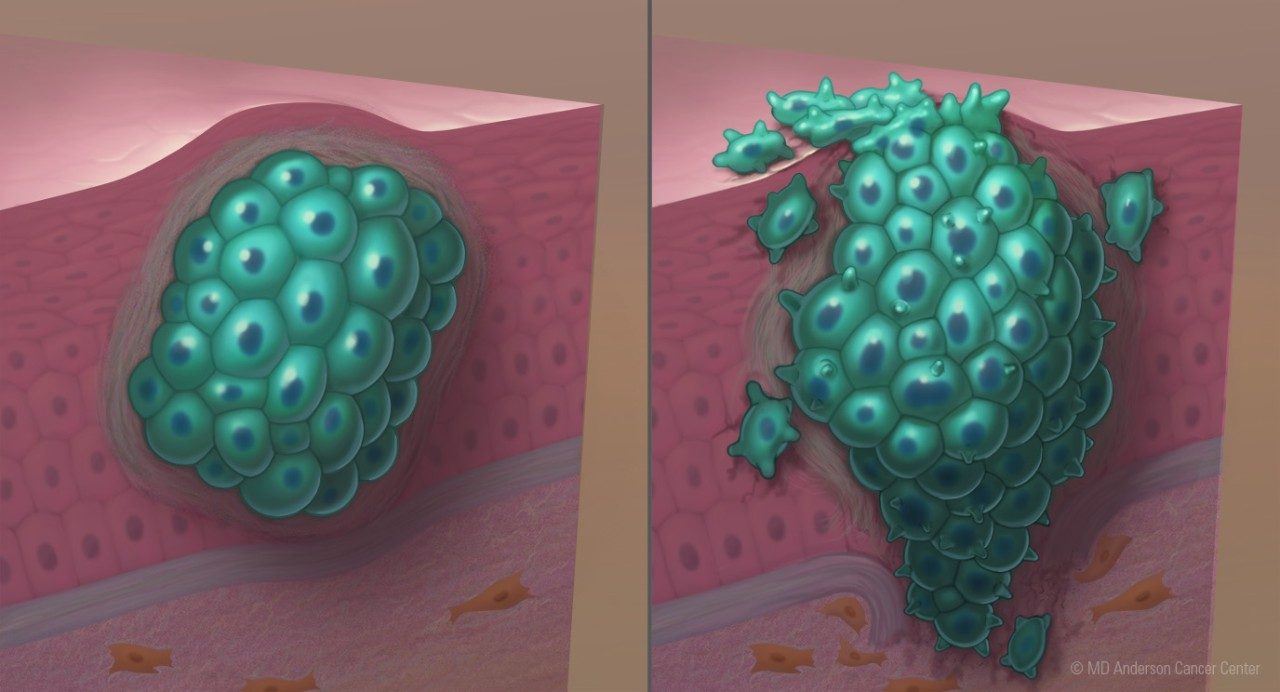 Side by side comparison of a benign tumor and a malignant tumor