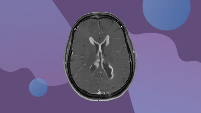 脑扫描显示浸泡性疾病