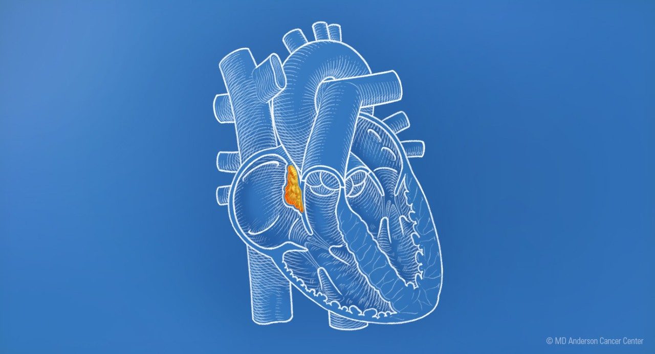 心脏的插图显示肿瘤