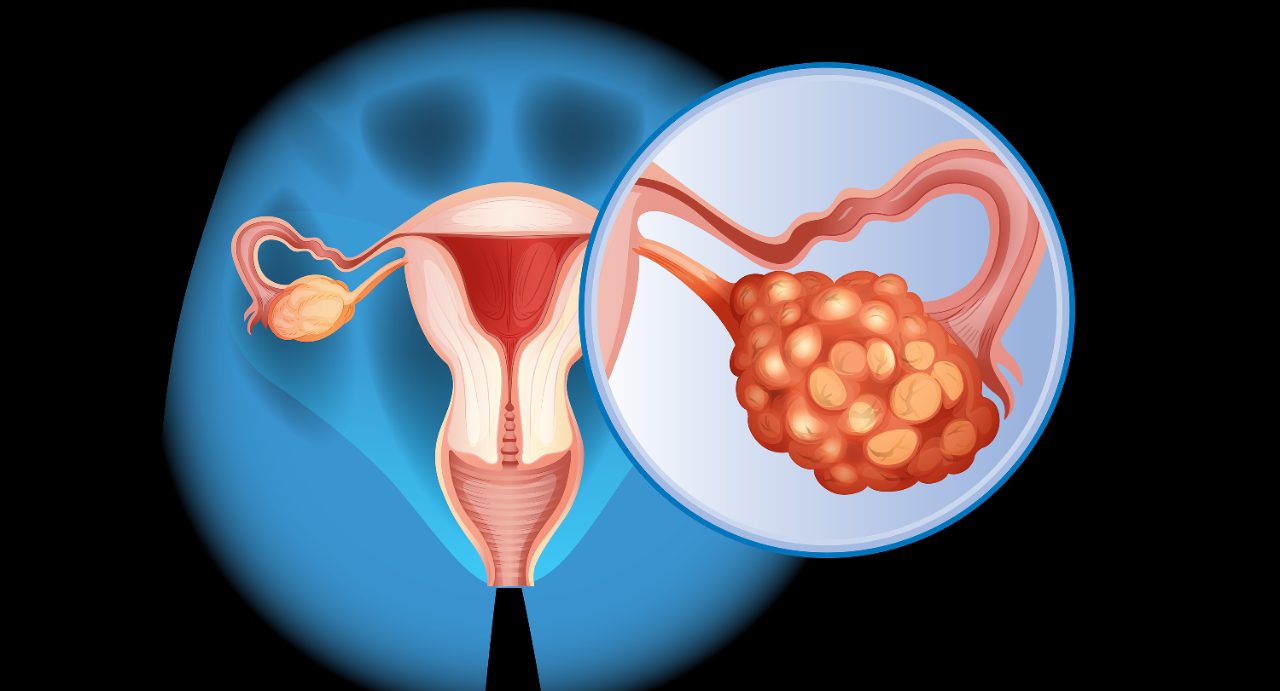 图的插图显示卵巢癌