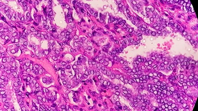 微镜状甲状腺癌细胞色素明粉色和紫色对比