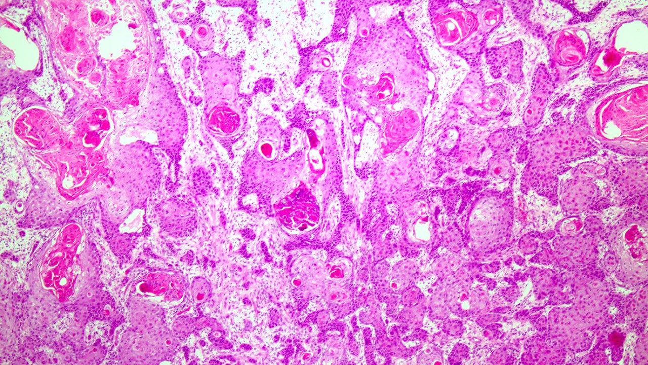 微观鳞状细胞癌的粉色和白色