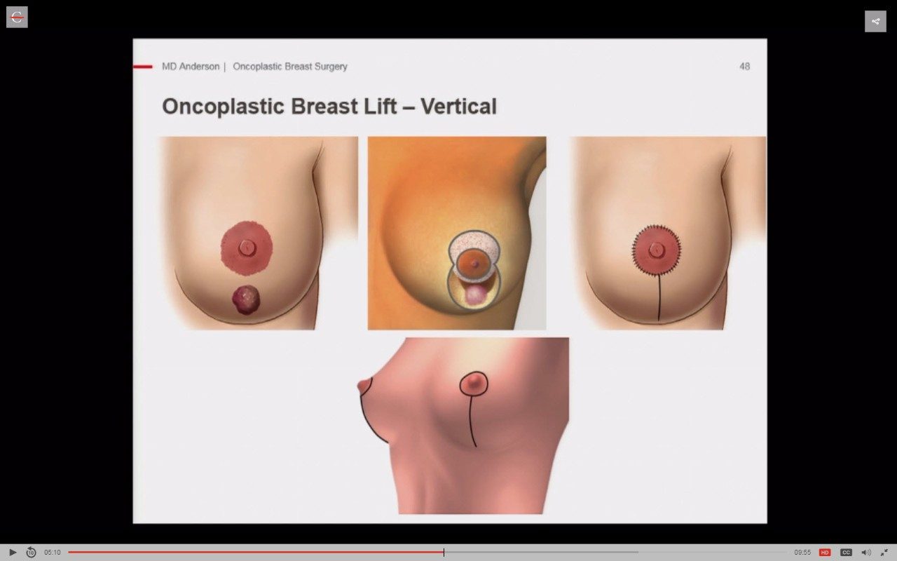 Oncoplastic乳房提升