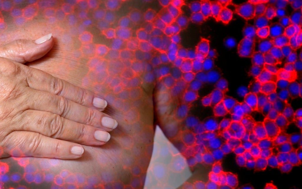 乳腺癌的临床小径组合治疗