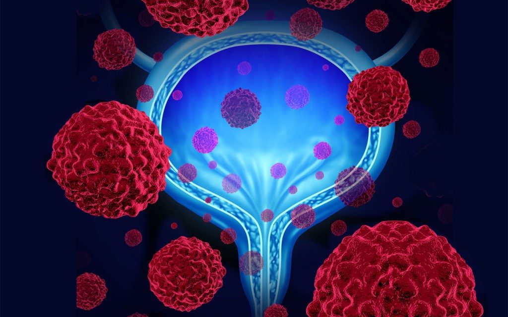 转移性膀胱癌的免疫治疗