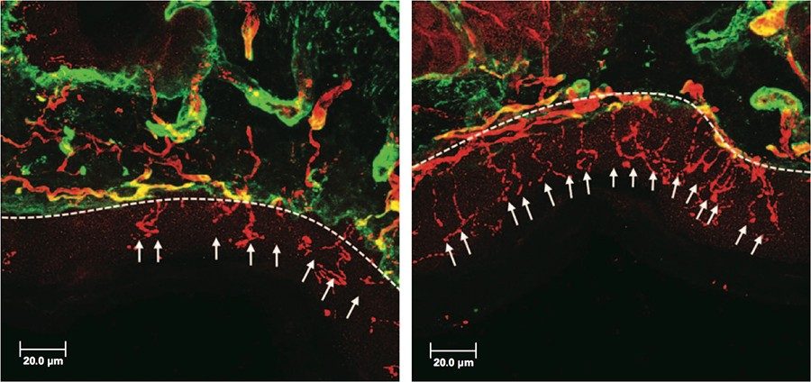 从小鼠与对照媒介物处理的顺铂诱导的神经病爪子活检标本的显微照片（左）或HDAC6抑制剂ACY-1083（右）表明ACY-1083反转表皮内神经纤维（IENF）损失，轴突的早期指标病理。