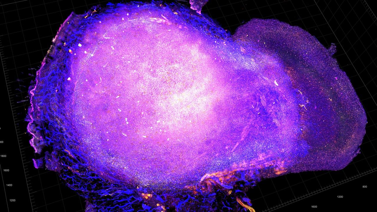 在放疗和免疫检查点阻断治疗后，T细胞攻击乳腺癌