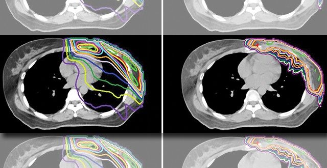 一名乳腺癌患者乳房切除后的放射治疗计划显示，接受光子治疗的患者心脏平均剂量为3.63戈瑞(左)，而接受质子治疗的患者心脏平均剂量仅为0.05戈瑞(右)。图片由Rebecca Howell医学博士提供