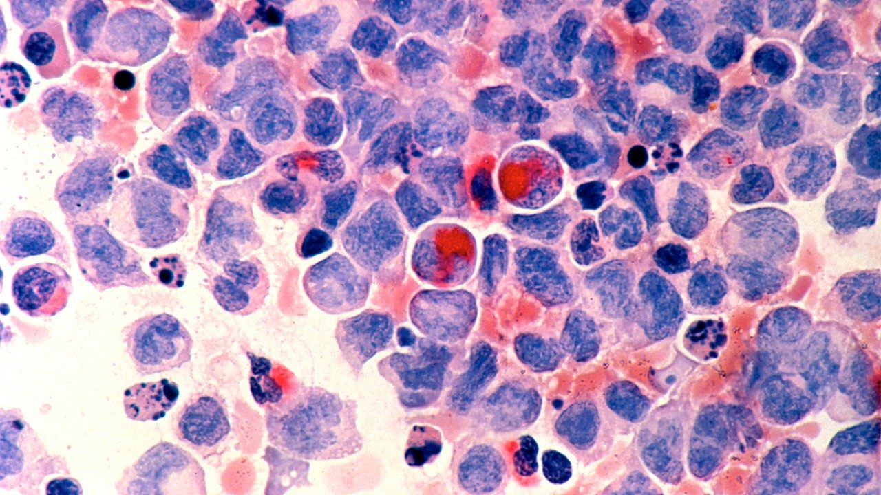 急性髓系白血病细胞