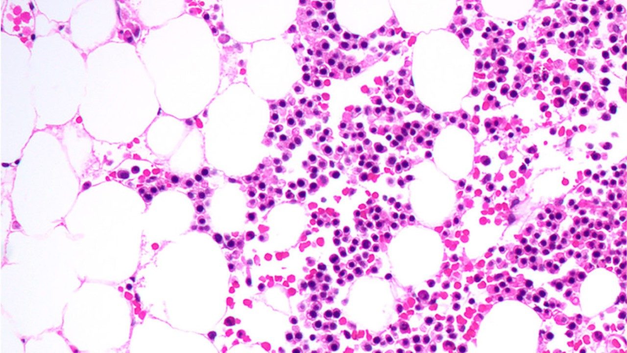 acute myeloid leukemia blasts