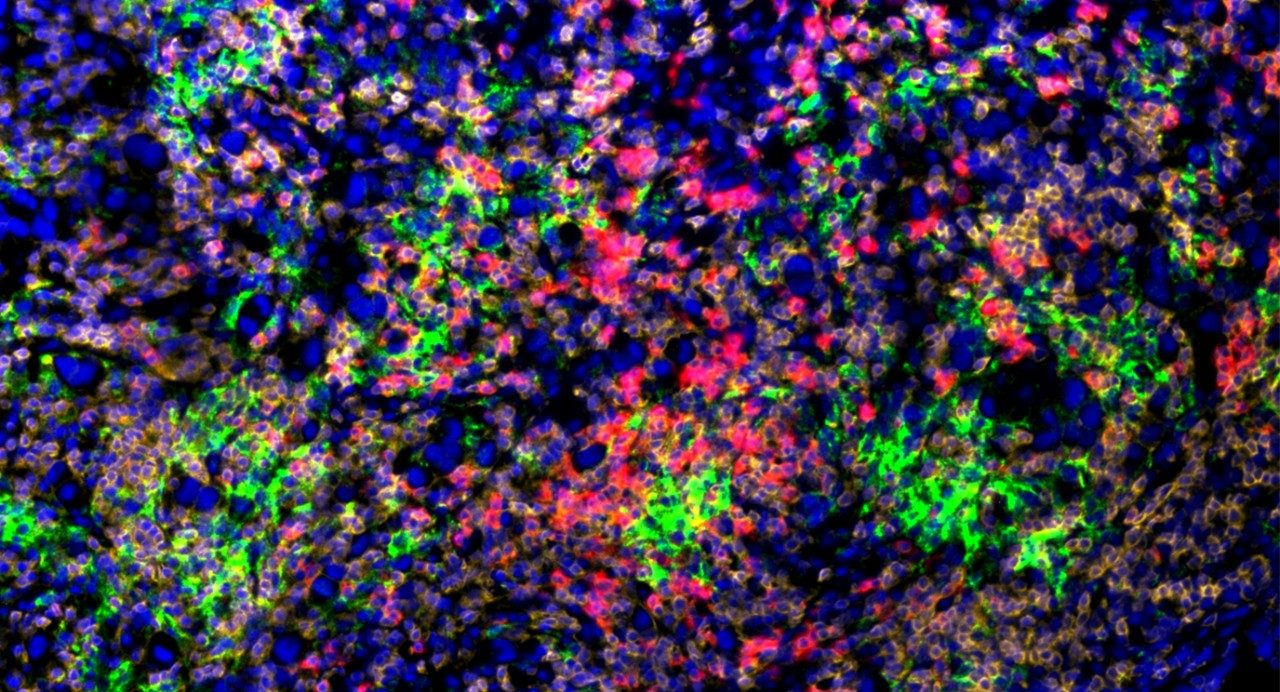 CD8阳性免疫系统的T细胞攻击癌细胞。