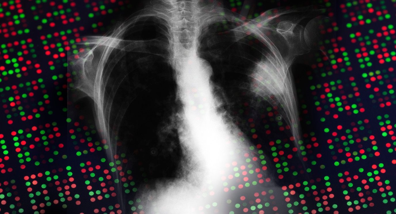 癌前生长和肿瘤分良性生长肺癌基因组进化的多区域的全基因组测序。
