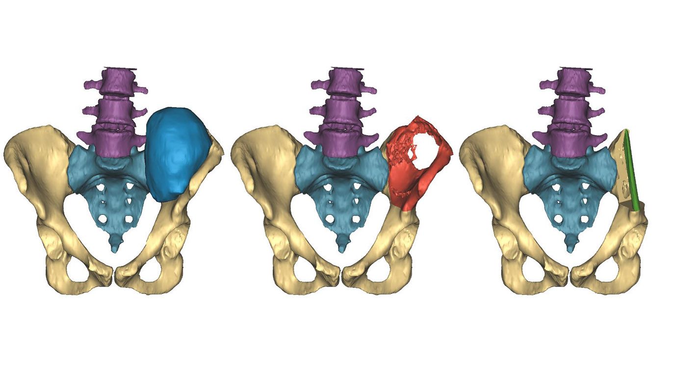 3D图像显示，左侧蓝色为初始肿瘤，红色为手术计划，右侧绿色为腓骨植入重建。图像中出现。