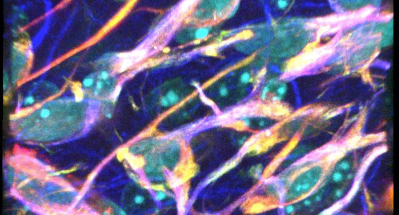 在二维摄像出现单独的神经胶质瘤细胞实际上被连接