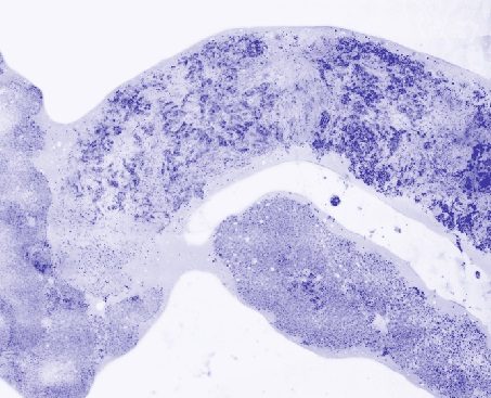 荧光共焦数字显微镜伪彩色图像核心针活检肝脏转移性腺癌