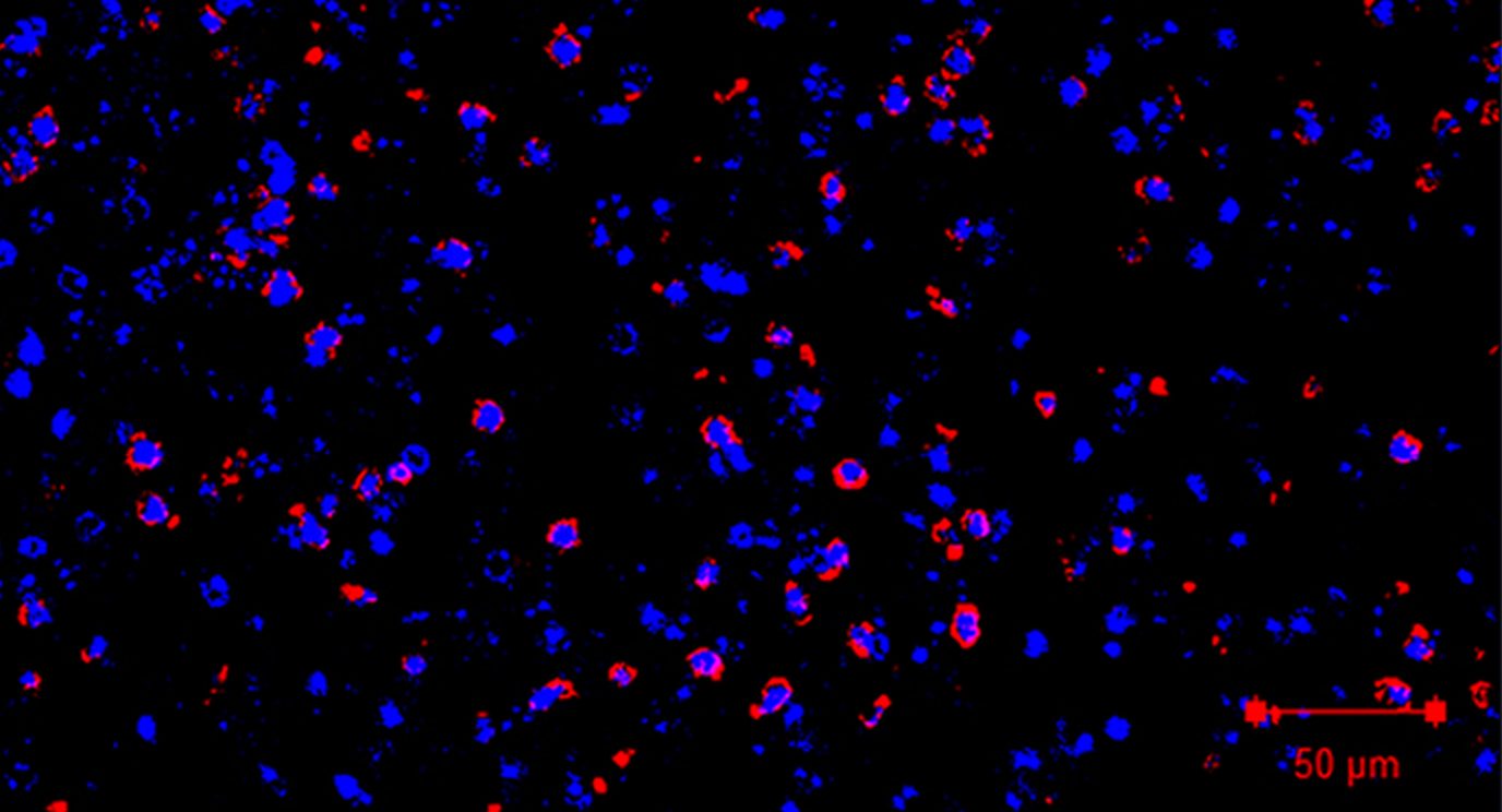 免疫荧光显示免疫抑制中性粒细胞渗透到脑转移中。