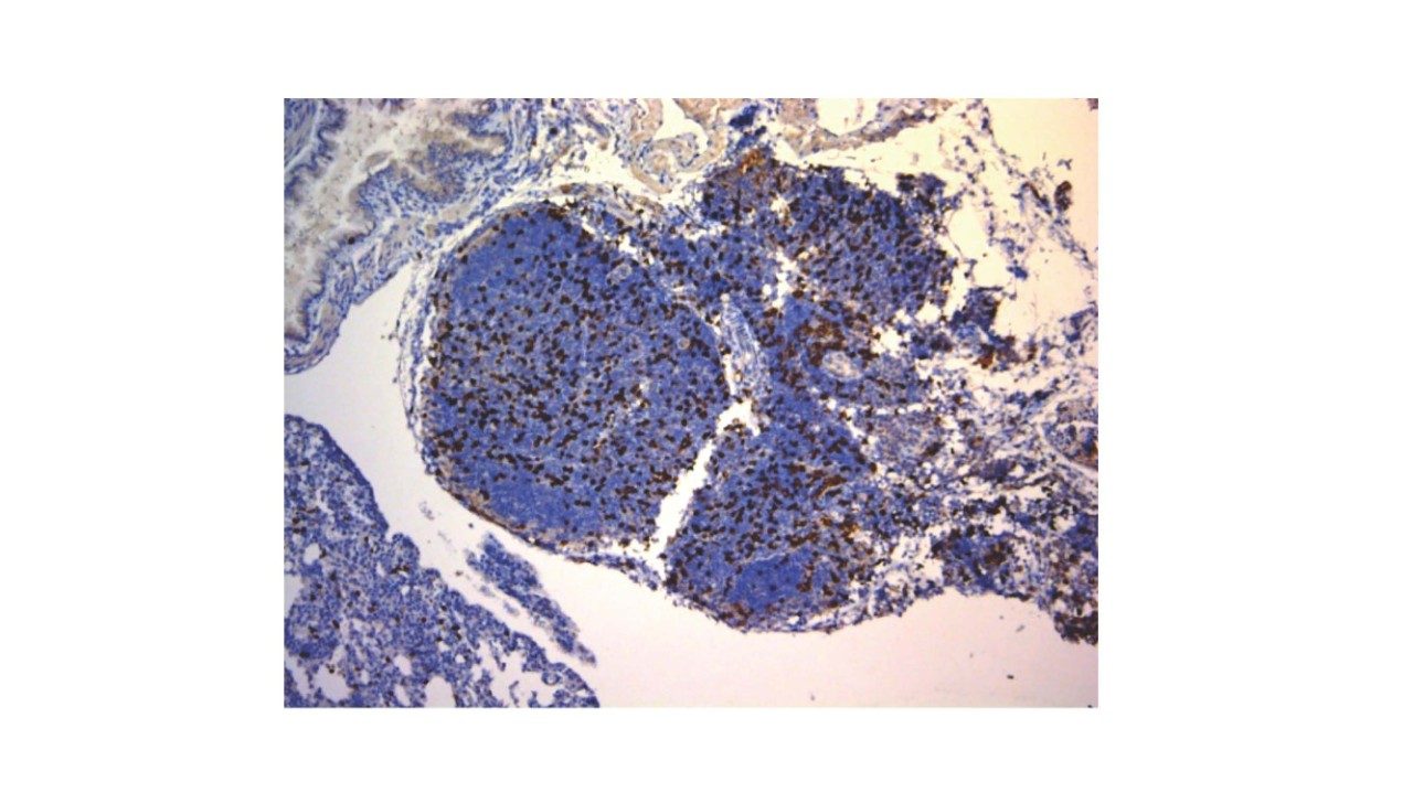 骨肉瘤肺代谢中的t细胞浸润