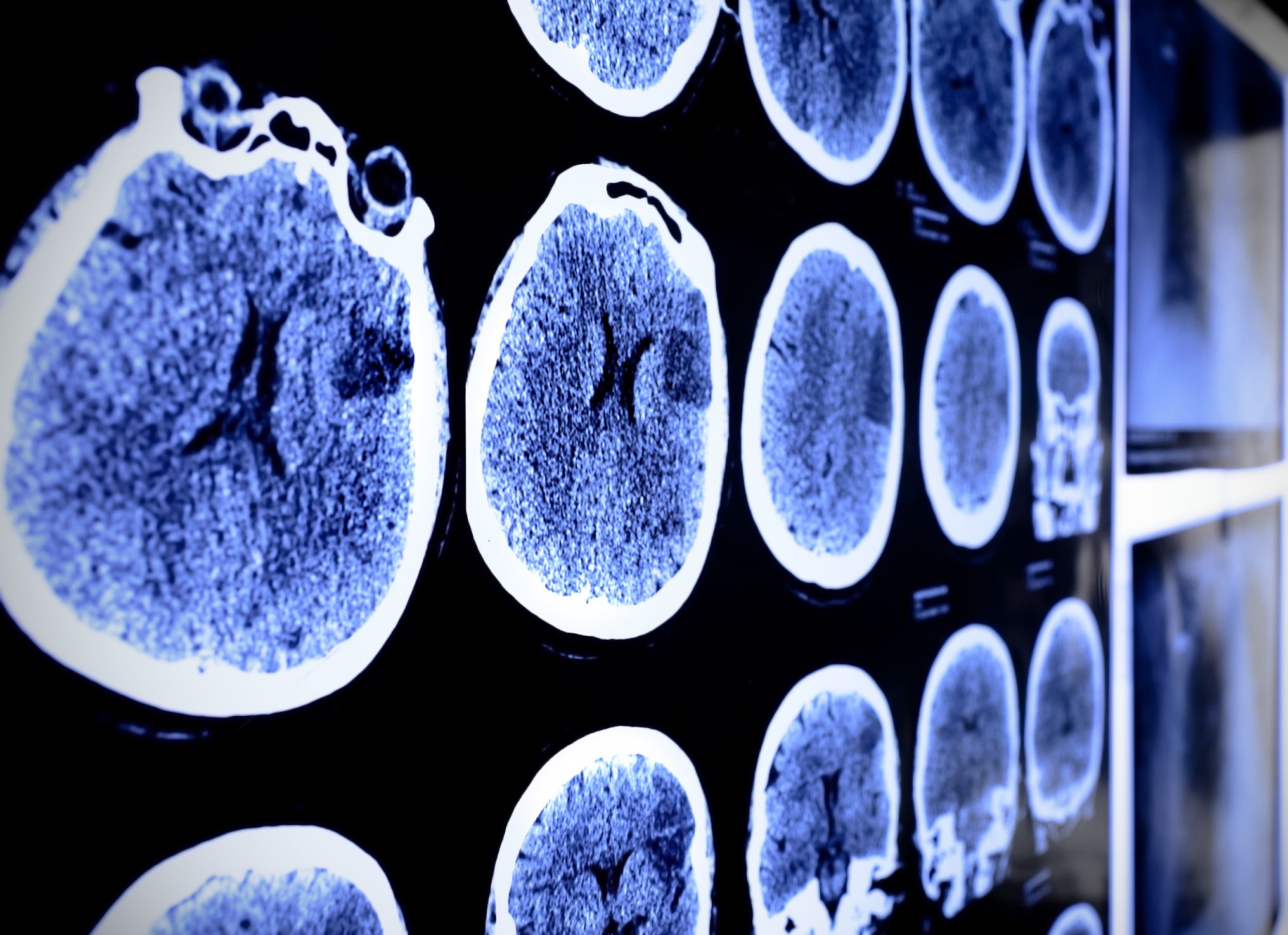Cancerwise博文：了解脑肿瘤，脑肿瘤的治疗和脑肿瘤的临床试验是什么